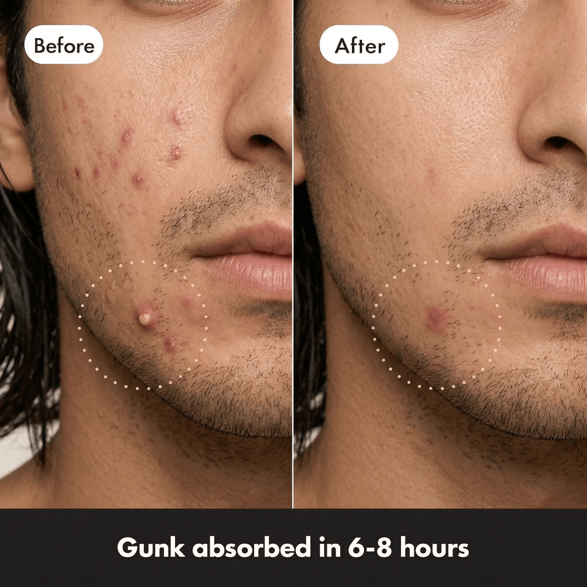 Pimple Patches - Aner